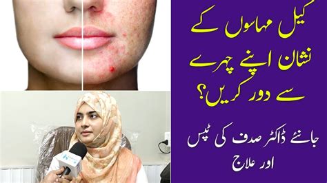 Keel Muhase Ka Gharelu Ilaj Acne Scar Removal Acne Treatment At