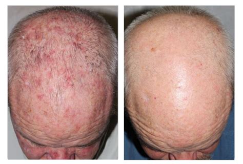 Before And After Pdt Pacific Dermatology Center
