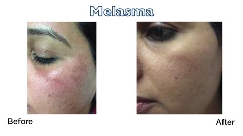 Stop several days before and resume one week after for the fraxel re:store. Melasma Before and After at Skin Perfect Brothers in ...