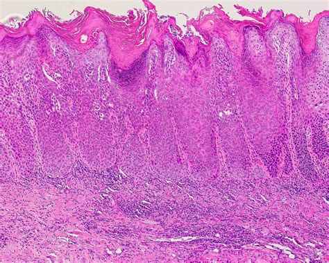 Proliferative Verrucous Leukoplakia Histology