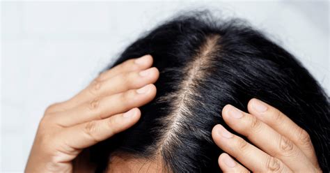 Scalp Ringworm Causes Symptoms And Treatment Options