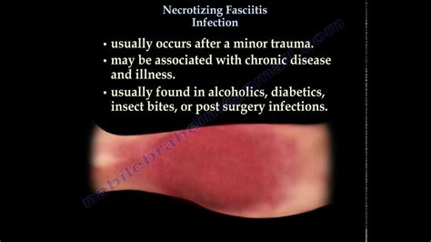 Necrotizing Fasciitis Everything You Need To Know Dr Nabil
