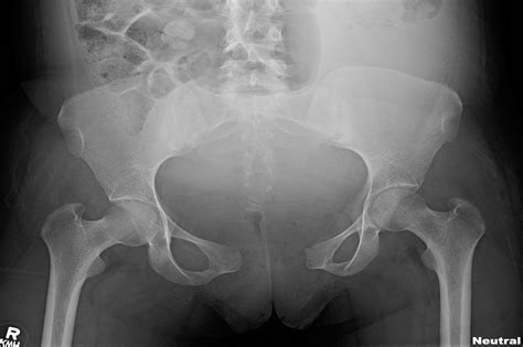 Pelvic Anatomy Xray Pelvic X Ray Stock Image P Science Photo Library