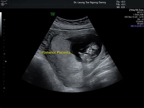 First Trimester Fetal Morphology Scan Hkog Info