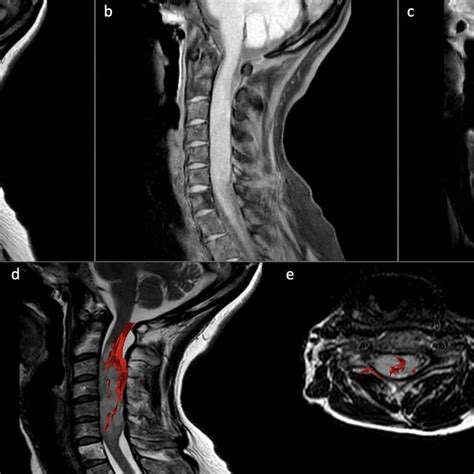 Sagittal T Weighted Mr Image Of The Cervical Spinal Cord A Showed A