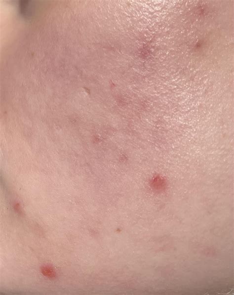Persistent Cystic Acne On Cheeks Racne
