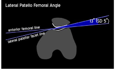 Lateral Patellofemoral Angle Download Scientific Diagram