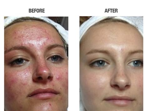 Pochen Abenteurer Zusammenbruch laser facial for acne Rudely Panik Säure