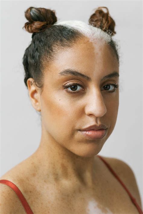 Vitiligo Beauty Photography Elisabeth Van Aalderen Vitiligo Beauty Vitiligo Women With Vitiligo