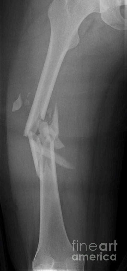 Fractured Femur Photograph By Rajaaisyascience Photo Library Fine
