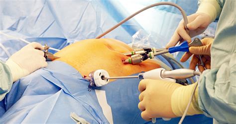 Diagnostic And Advanced Laparoscopic Surgery Dr Yogesh Bang