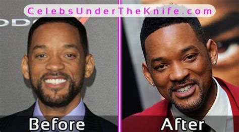 Will Smith Plastic Surgery Before After Celebsundertheknife Celebs