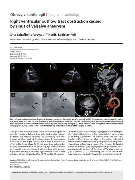 Pdf Right Ventricular Outflow Tract Obstruction Caused By Sinus Of