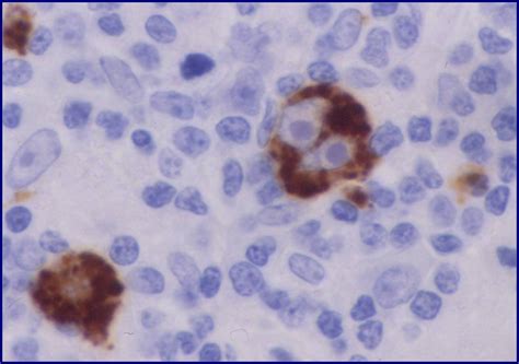 This disease is characterized by the presence of sternberg cells (rs) is an examination by microscope. Healthy Body-Healthy Mind: Hodgkin's vs Non-Hodgkin's lymphoma