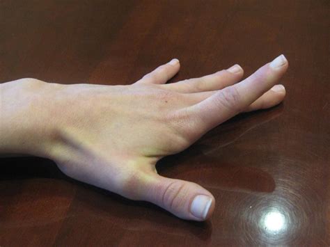 How to Reduce Hands Fat | Healthcare-Online