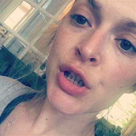 Fearne Cotton Shares Photo Of Braces And Fans Praise Her For Being