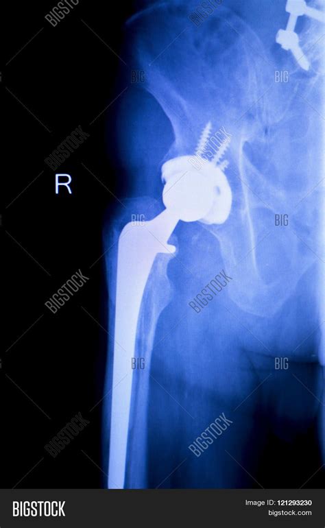 Hip Replacement Xray Image And Photo Free Trial Bigstock