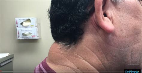 Watch Dr Pimple Popper Blast The Massive Zit On Mans Neck Video John Hawkins Right Wing News