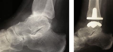 Ankle Arthritis 🩺singapore Sports And Orthopaedic Surgeon