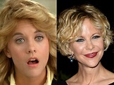 Meg Ryan Plastic Surgery - Before and After Photos