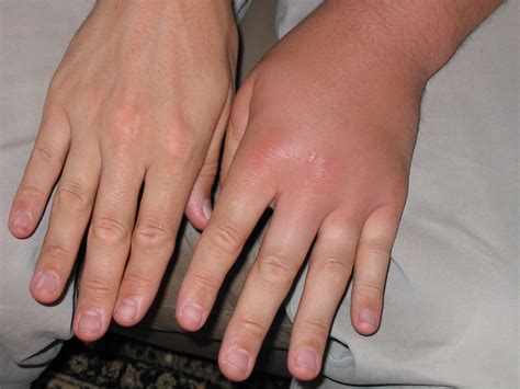 Maybe you would like to learn more about one of these? Yellow Jacket sting | Flickr - Photo Sharing!