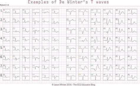Case study looking at the stemi equivalent of de winter t waves for lad occlusion. ECG Educator Blog : De Winters T waves