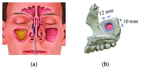 Maxillary Sinus Position A Front View And B Left View Download