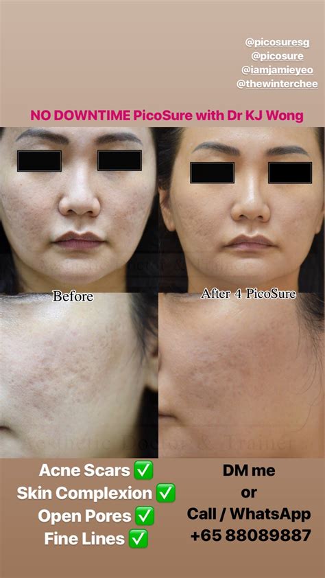 Acne Scar Treatments Singapore Best Acne Scar Treatments 2020