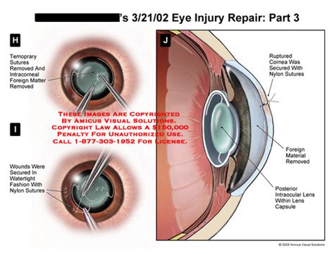 Amicus Illustration Of Amicussurgeryeyerepairlensintraocular