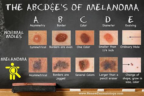 The Abc D And Es Of Melanoma