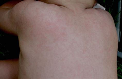 Roseola Symptoms Causes And Treatment