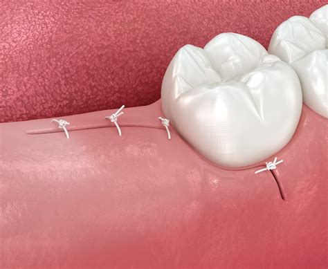 Post Op Care After Wisdom Teeth Removal Carolinasdentist