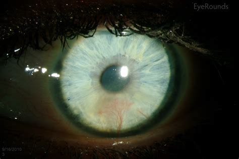 Noninfectious keratitis can be caused by a relatively minor. Herpes Simplex Keratitis