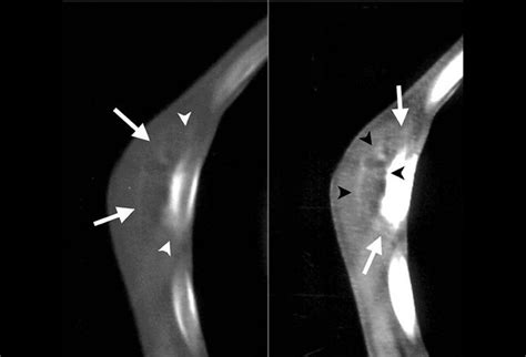 Osteosarcoma Chondrosarcoma And Ewing Sarcoma Bred In The Bone