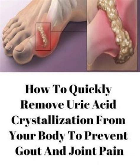 How To Remove Gout And Joint Pain Uric Acid And Crystals