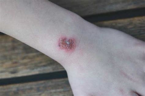 What Does Staph Infection Look Like