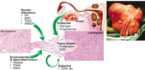 Etiology Of Uterine Fibroids Leiomyomas Are Heterogenous In Their