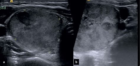 Malignant Thyroid Nodules Ultrasound