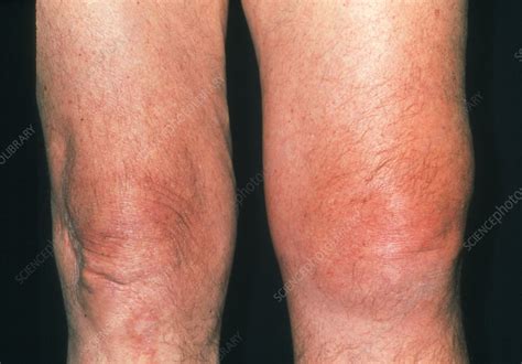 Inflamed Knee Of An Elderly Man Affected By Gout Stock Image M165