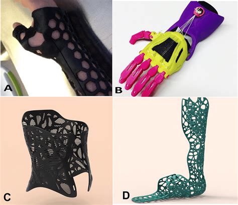 Examples Of 3d Printed Orthotics A Forearm Static Fixation Courtesy