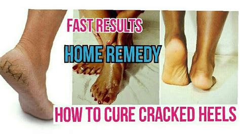 How To Cure Cracked Heels Fast Home Remedy Dry And Painful Crac