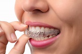 隱適美如何矯正牙齒？一篇帶你掌握效果、缺點及價格 - 循映牙醫診所
