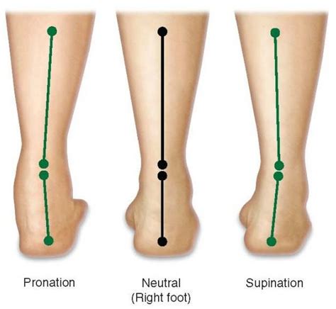 Pioneer Podiatry Flat Feet Collapsing Arches Over Pronation And High