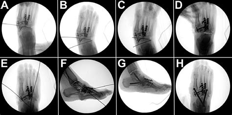 Realignment Midfoot Osteotomy A Preoperative Planning Method And