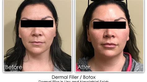44 Dermal Filler Lips Nlf Botox Skin Rejuvenation Clinic Skin