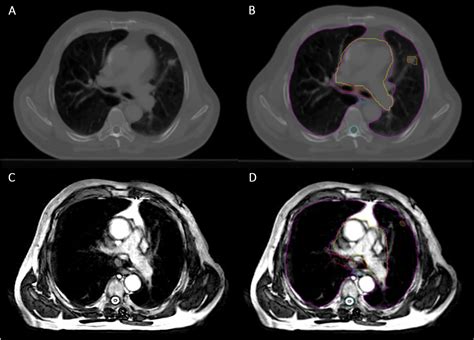 Lung Cancer Mri