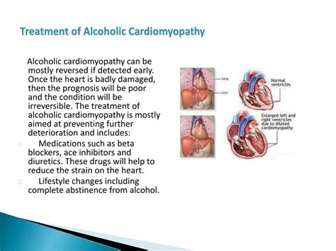 Ppt Alcoholic Cardiomyopathy Powerpoint Presentation Free Download