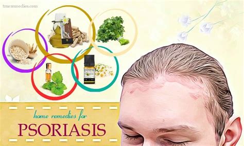 25 Home Remedies For Psoriasis On Face Hands Legs And Scalp