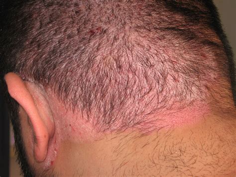 Tips On How To Treat Scalp Psoriasis Skin Care Tips From Dermatologist