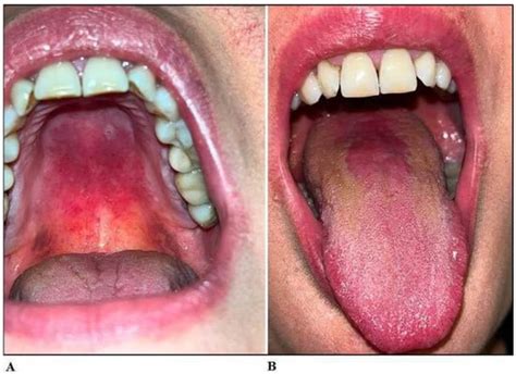 Jof Free Full Text An Unconventional Oral Candidiasis In An